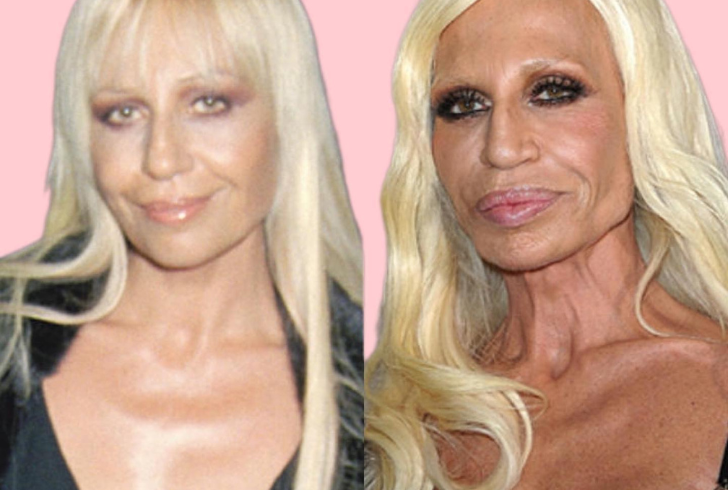 Donatella Versace before and after plastic surgery.